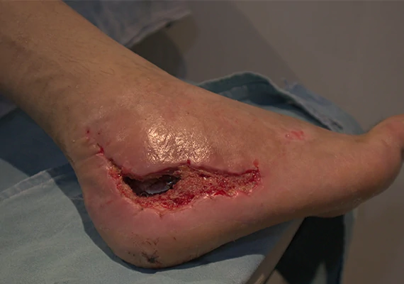 curacion herida quirurgica