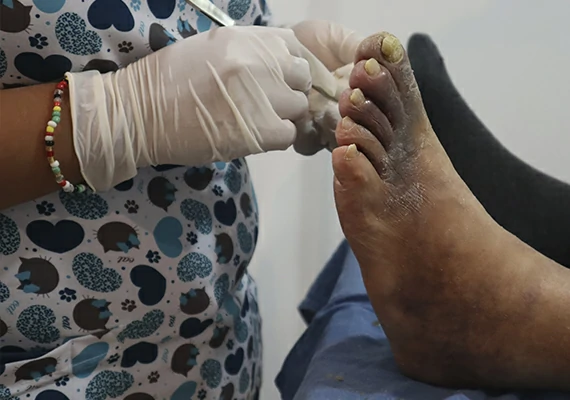 curacion pie diabetico