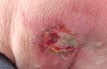 Úlcera por presión escara