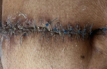 Herida quirúrgica herida quirurgica