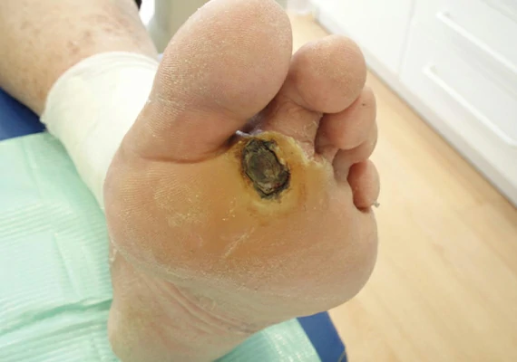 pie diabetico curacion