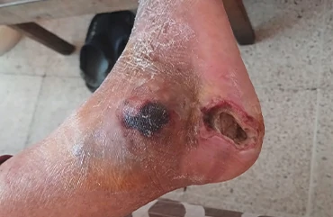 Pie diabético pie diabetico