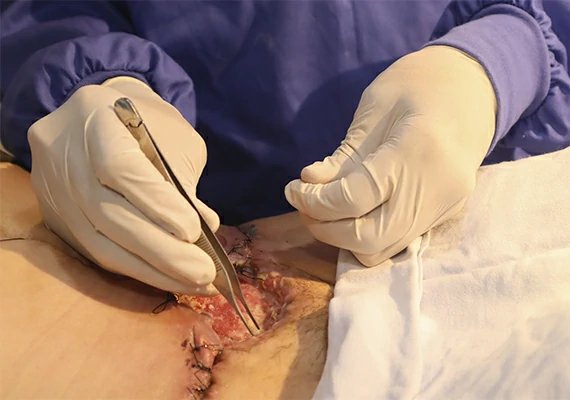 Infección herida quirurgica