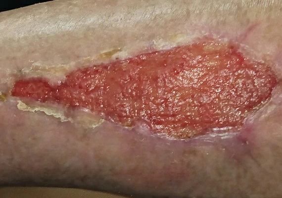 Tratamiento ulcera venosa