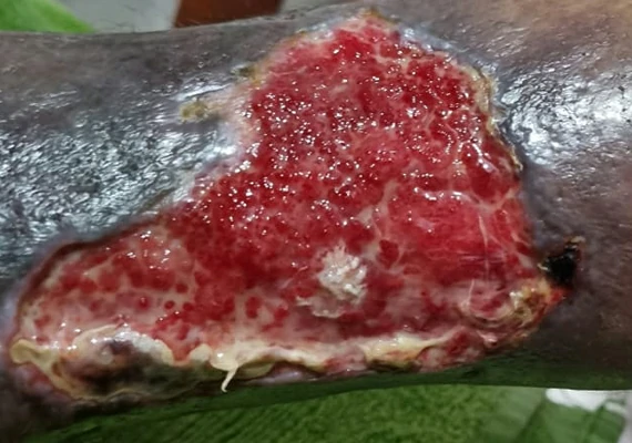 ulcera venosa y arterial