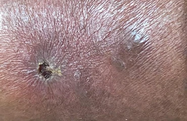 Úlcera venosa ulcera varicosa